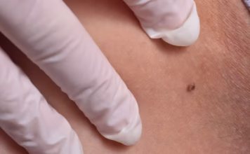 remove skin tags at home remove skin tags at home